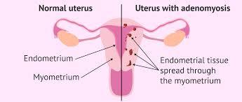Normal Uterus on the left, Adenomyosis on the right – the endometrial glands grow into the myometrium, or muscle of the uterus.