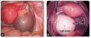 Endometrioma in the right ovary. Endometrioma in the left ovary with normal right ovary. Picture from JAM