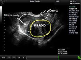 Hysterosonogram showing a fibroid in the uterine cavity, which is filled with water.