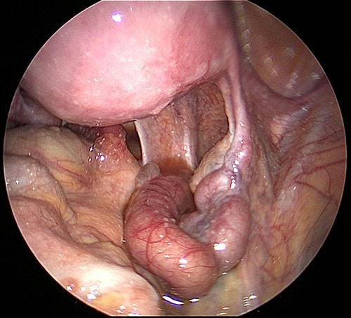 Hydrosalpinx right tube