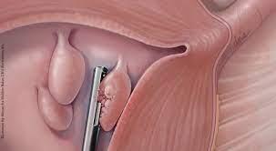 Uterine polyps being removed with hysteroscopy