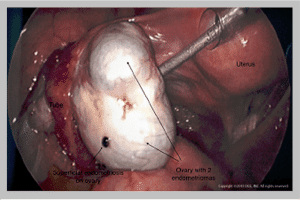 Labeled image showing an ovary with 2 endometriomas