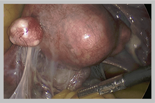 Close up showing pelvic adhesions