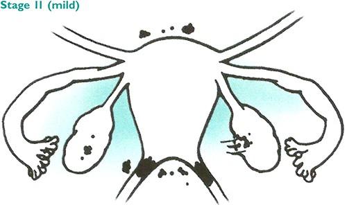 Stage 2 mild